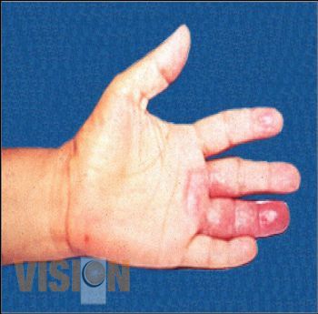 Refuerzan búsqueda intensiva de casos de lepra