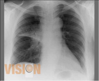 Refuerzan durante esta semana actividades para detectar la tuberculosis