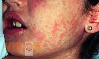 Refuerzan vigilancia epidemiológica para la detección de casos de sarampión