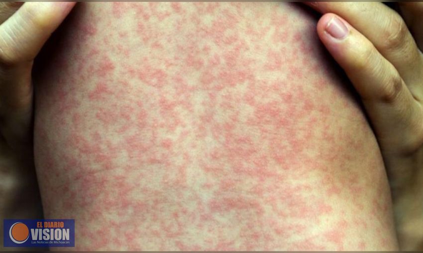 Reportan cuatro casos de sarampión en CDMX; no estaban vacunados