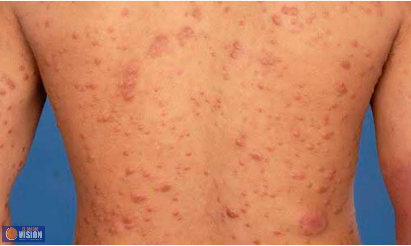 Sinaloa, Michoacán y Jalisco, los estados con más casos de lepra en el país